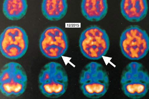 PET scan showing brain improvement after HBOT